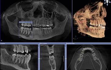 Dental implant image